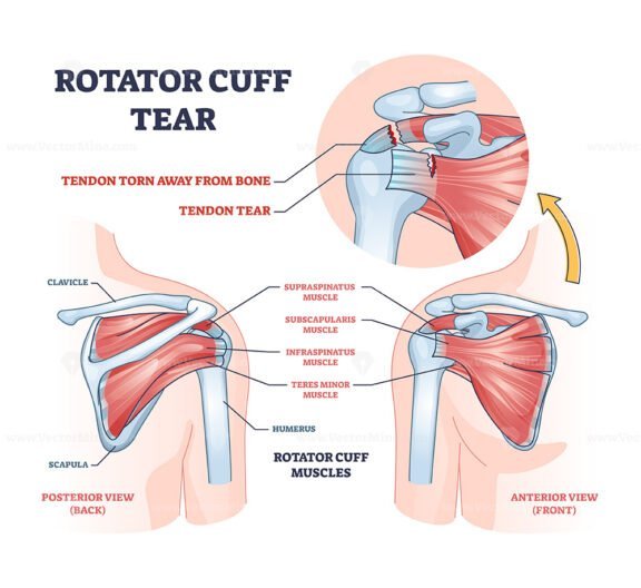 rotator cuff tear outline 1
