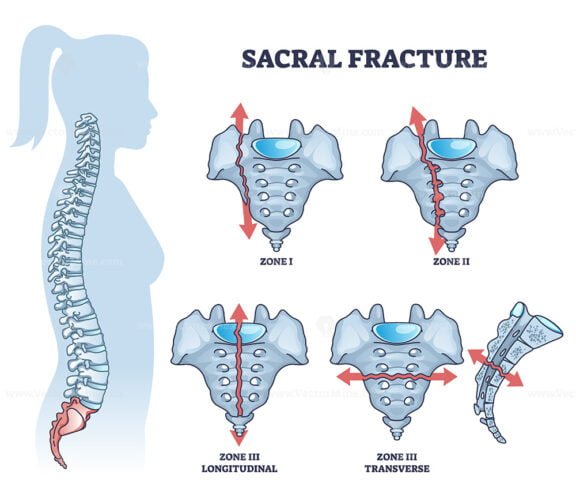 sacral fracture outline 1