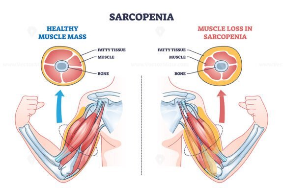 sarcopenia outline diagram 1