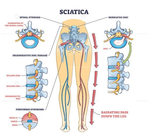 sciatica 3 outline 1