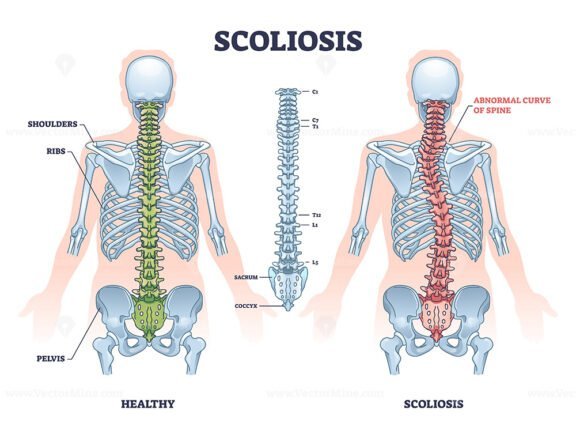 scoliosis outline 1