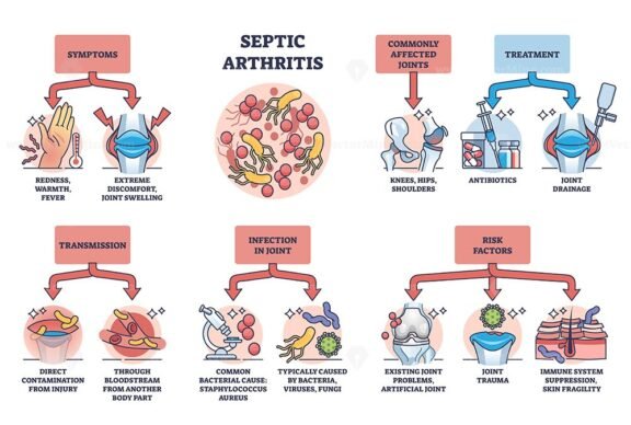 septic arthritis diagram outline diagram 1