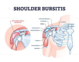 shoulder bbursitis outline diagram 1