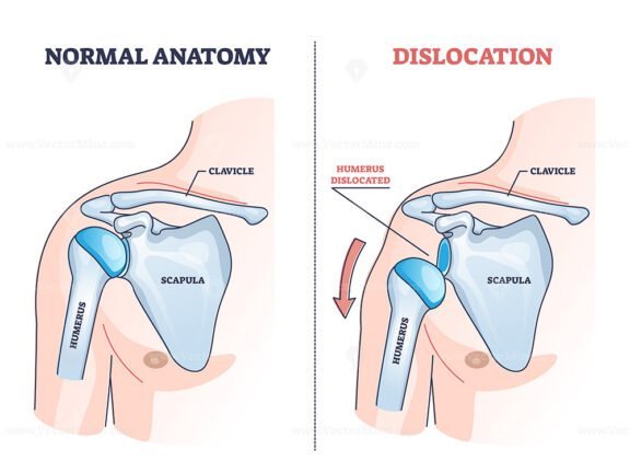 shoulder dislocation outline diagram 1