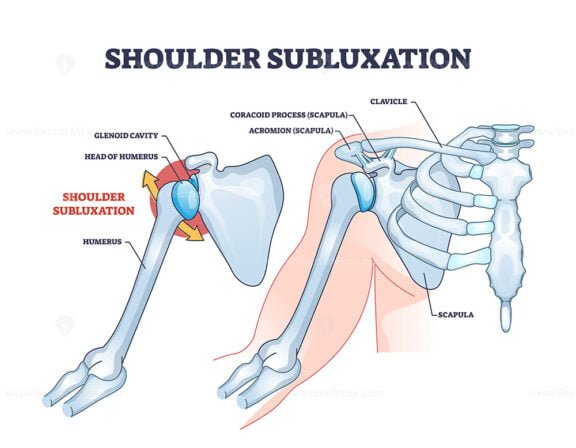 shoulder subluxation outline 1