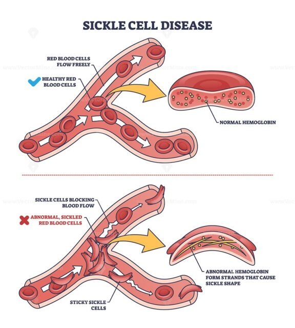 sickle cell disease outline diagram 1