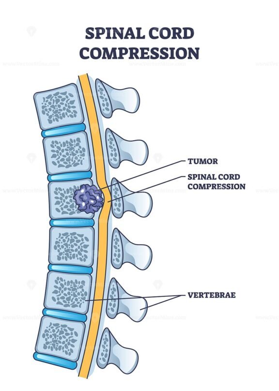 spinal cord compression outline 1