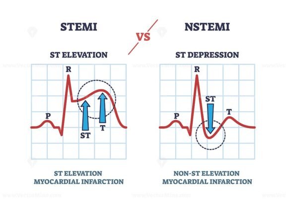 stemi vs nstem outline 1