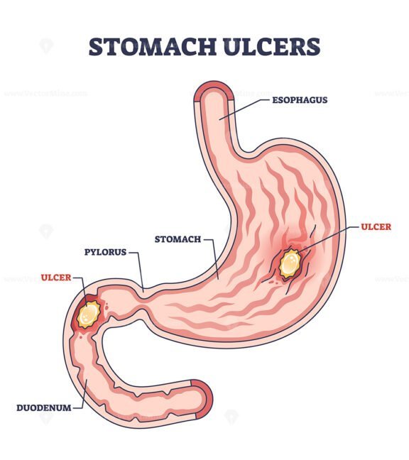 stomach ulcer outline diagram 1