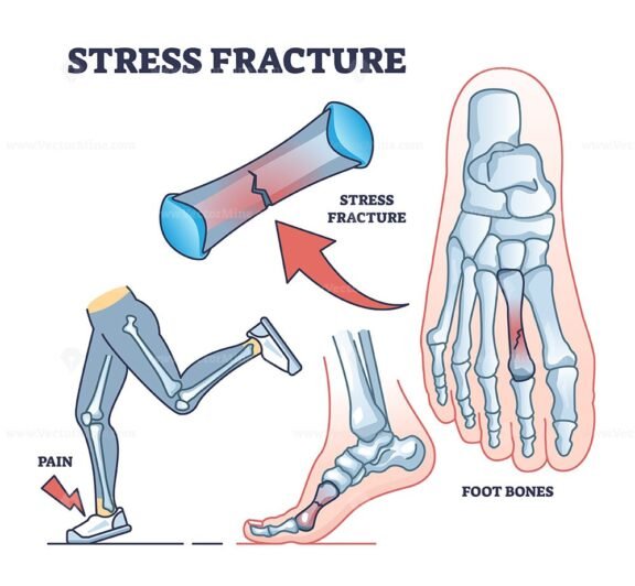 stress fractures v2 outline diagram 1