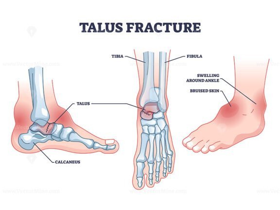 talus fracture outline 1