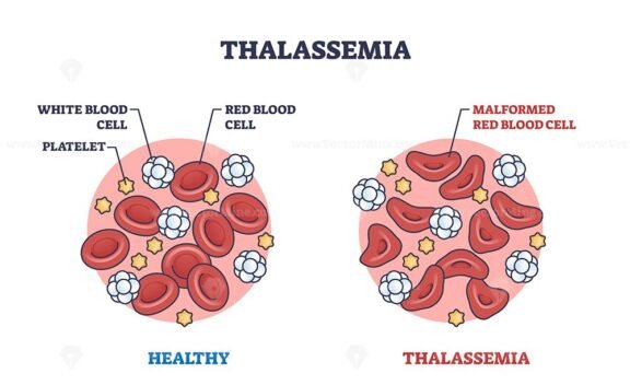 thalassemia outline diagram 1