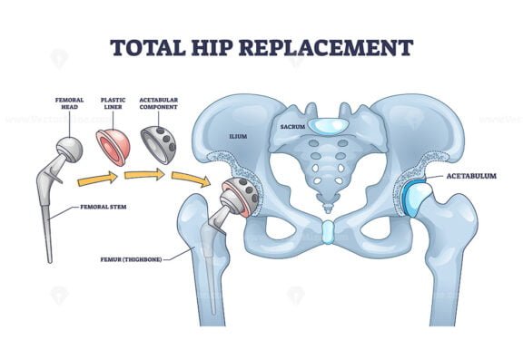total hip replacement outline diagram 1
