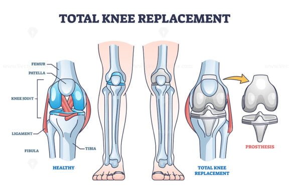 total knee replacement outline diagram 1