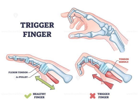 trigger finger outline 1