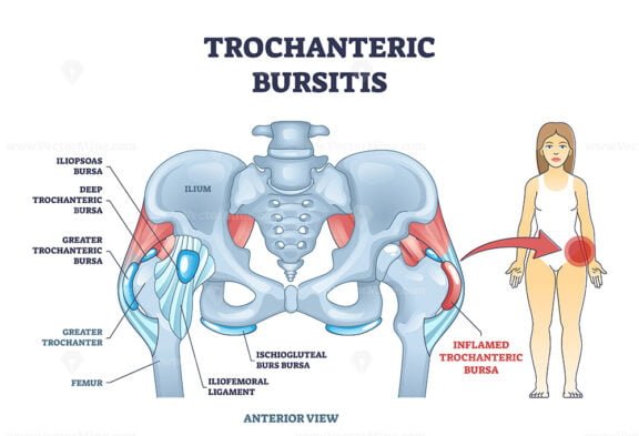 trochanteric bursitis outline 1