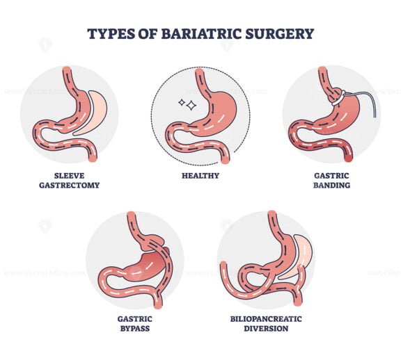 types of bariatric surgery outline diagram 1