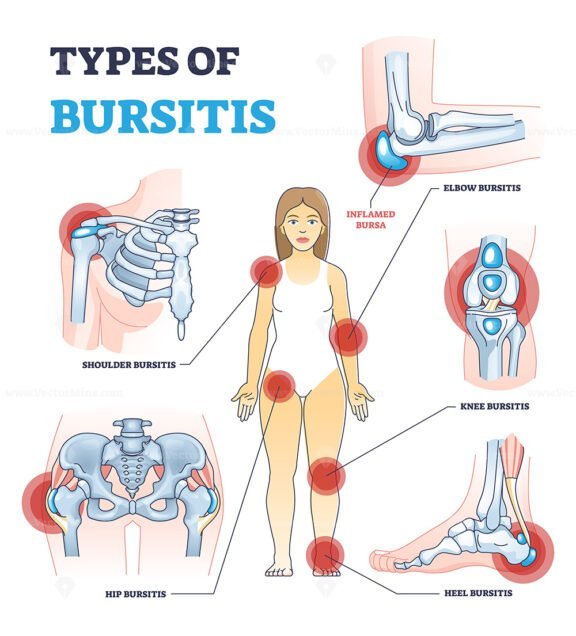 types of bursitis outline diagram 1