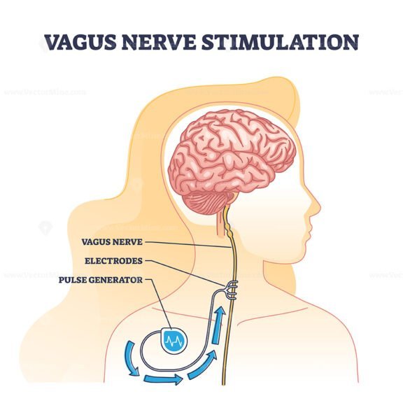 vagus nerve stimulation outline 1