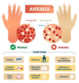 Anemia vector illustration - VectorMine