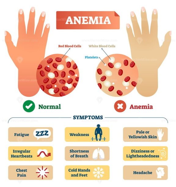 Anemia