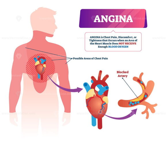 Angina vector illustration