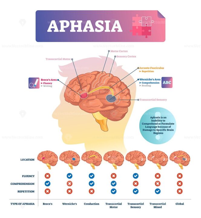 Aphasia vector illustration – VectorMine