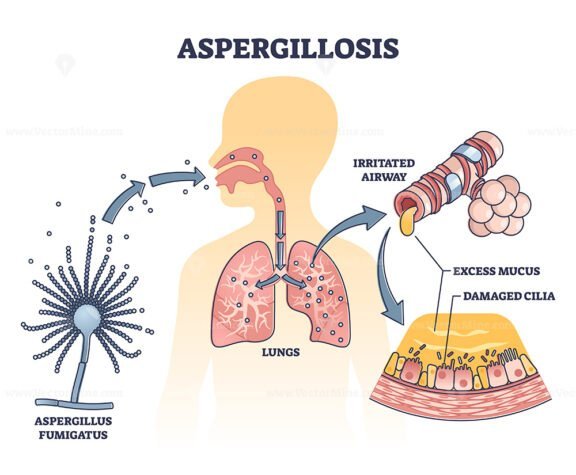Aspergillosis outline