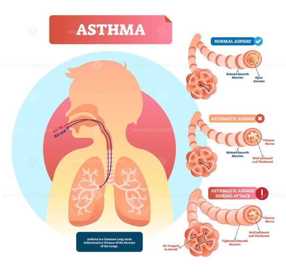 Asthma