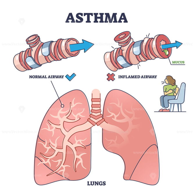 Asthma health condition compared normal and inflamed airway outline ...