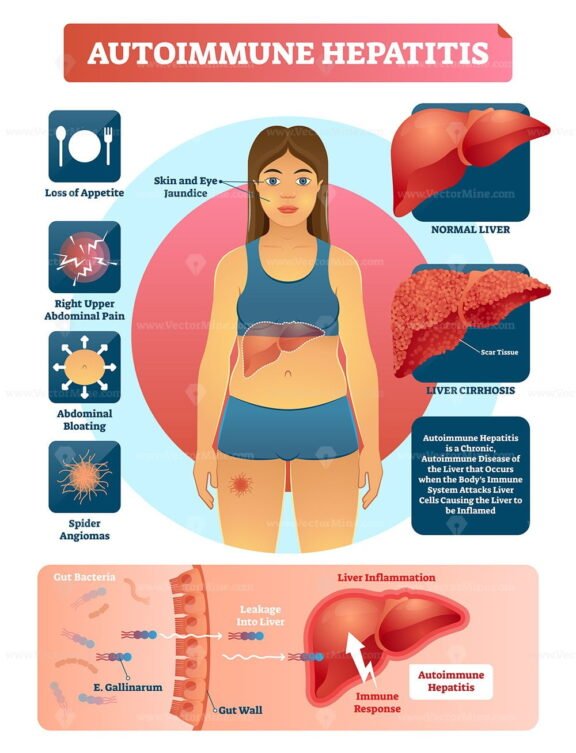 Autoimmune Hepatitis