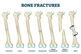 FREE Bone fractures vector illustration – VectorMine