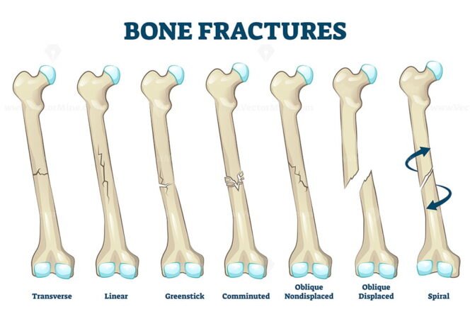 FREE Bone fractures vector illustration – VectorMine