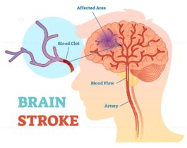 Brain stroke anatomical vector illustration – VectorMine