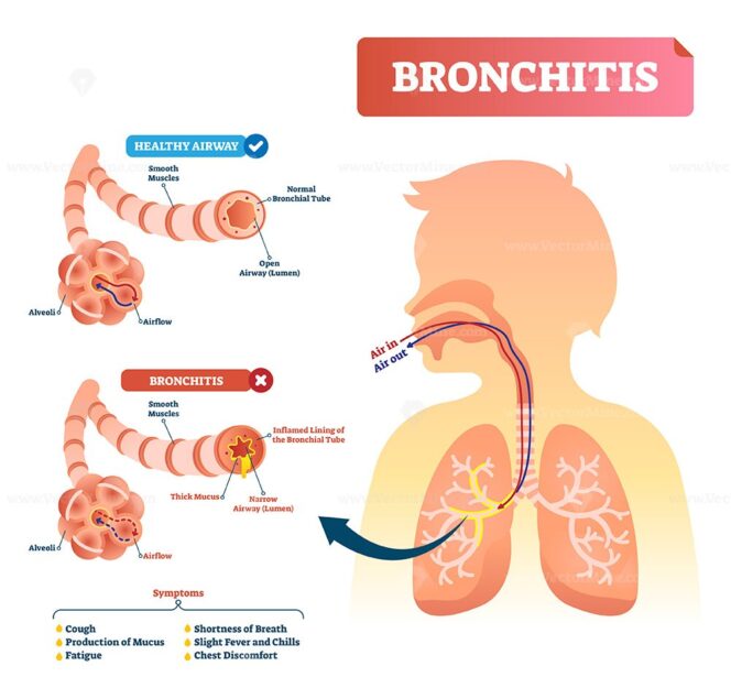 Bronchitis vector illustration – VectorMine