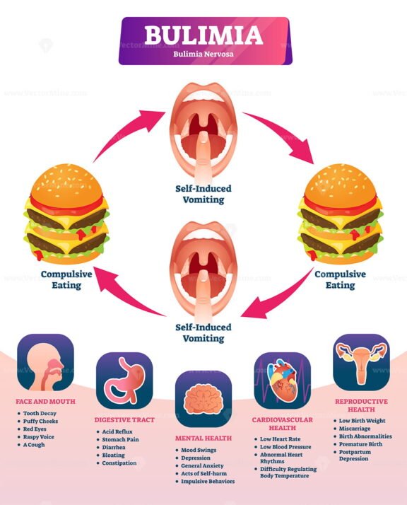 Bulimia Diagram