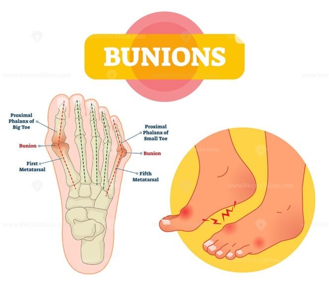 Bunions vector illustration – VectorMine