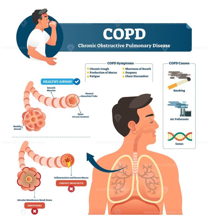 COPD vector illustration - VectorMine