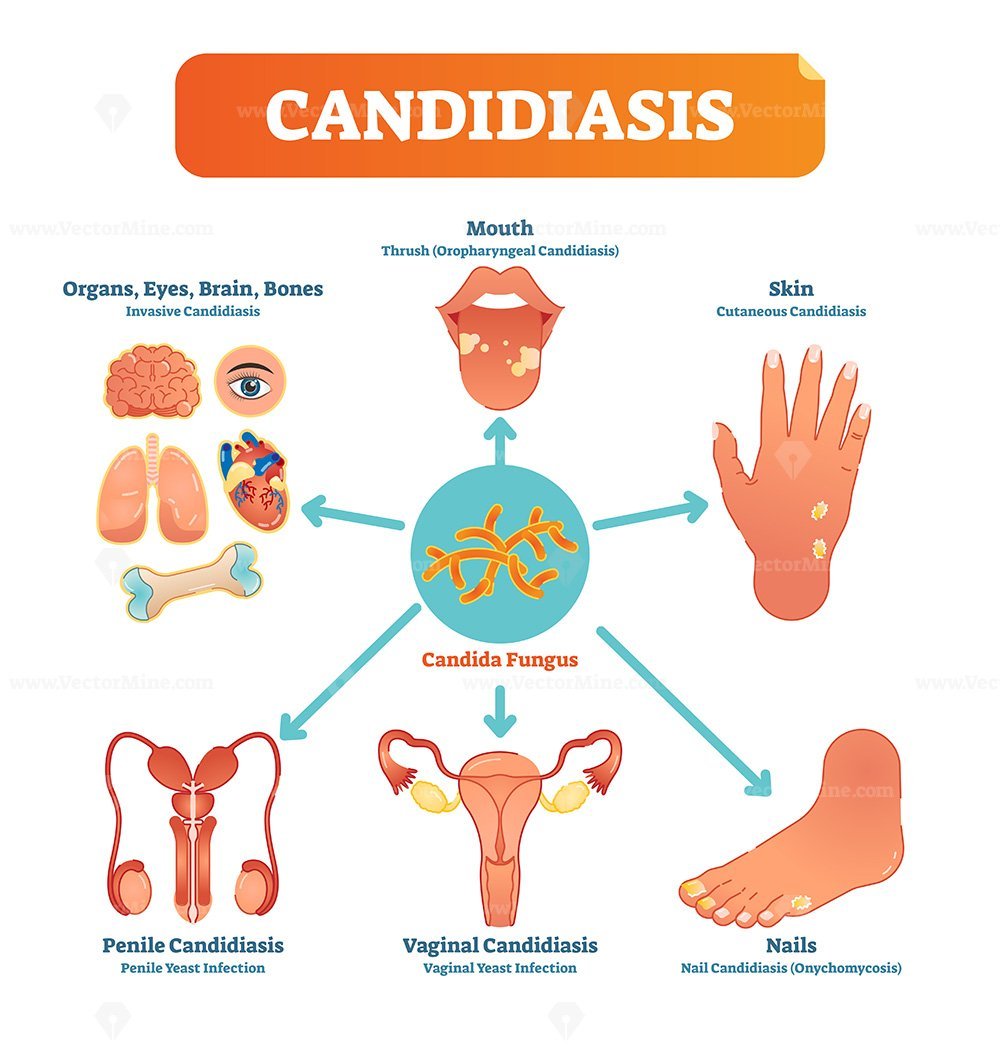 signs-of-candida-hot-sex-picture