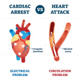 Cardiac arrest vs heart attack vector illustration - VectorMine