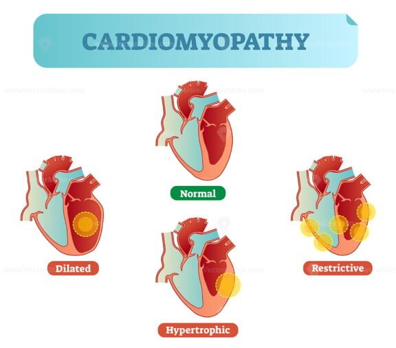 Cardiomyopathy