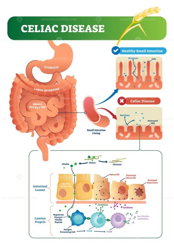 Celiac Disease