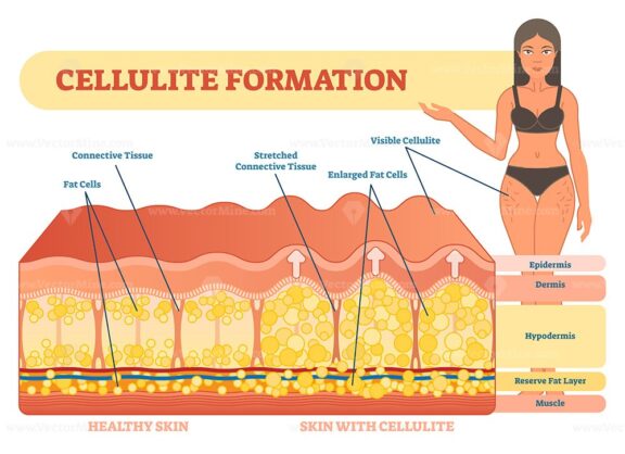 Cellulite Formation