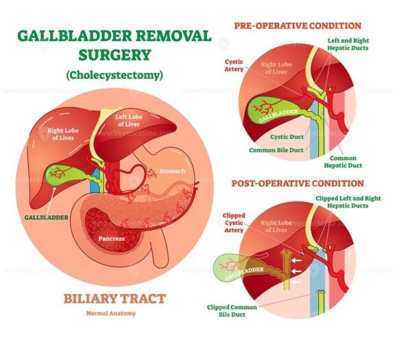 Cholecystectomy