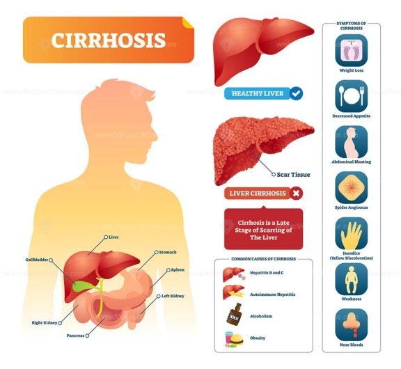 Cirrhosis