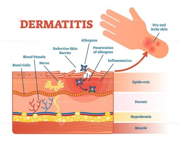 Dermatitis