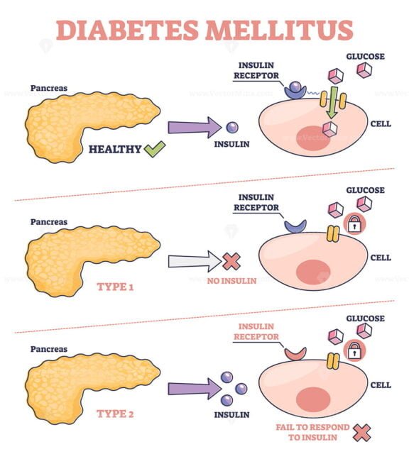 Diabetes Mellitus As High Blood Sugar And Metabolic Illness Outline Diagram Vectormine