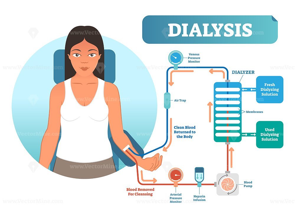 Dialysis medical procedure system vector illustration diagram VectorMine