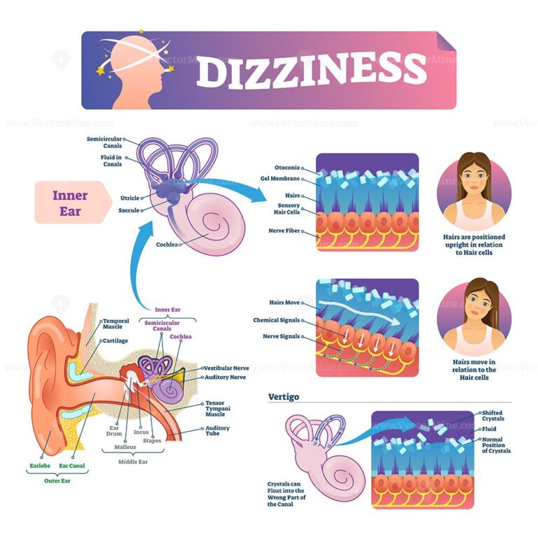 Dizziness vector illustration - VectorMine