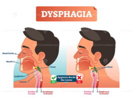 Vector illustration about dysphagia and compered it in scheme - VectorMine